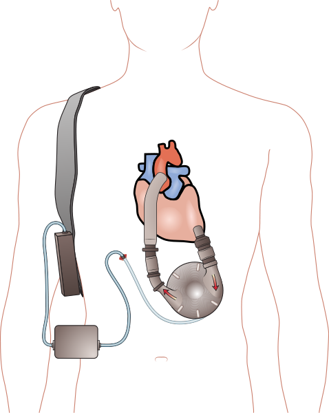 Pierce-Donachy Ventricular Assist Device